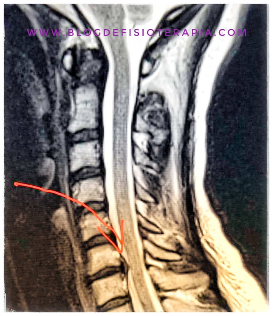 Hernia Discal Cervical Blog De Fisioterapia 9999