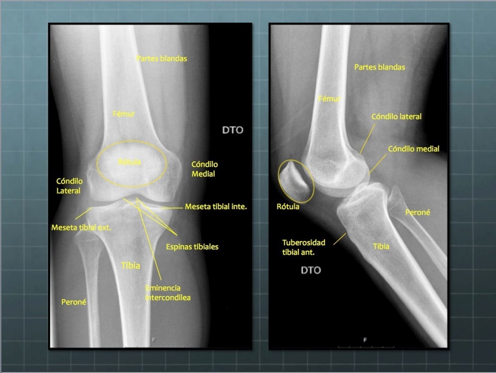 RADIOGRAFÍA ANTEROPOSTERIOR Y LATERAL RODILLA – Blog De Fisioterapia