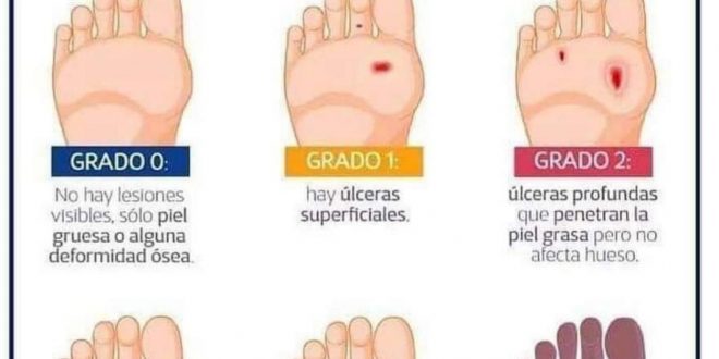 Grados De LesiÓn En El Pie DiabÉtico Blog De Fisioterapia 9670