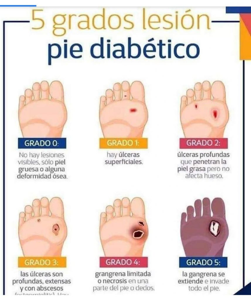 Grados De LesiÓn En El Pie DiabÉtico Blog De Fisioterapia 3428